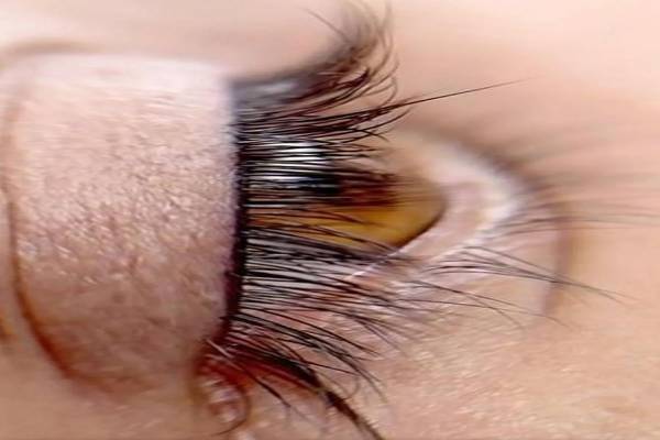 فیبروز شیدینگ لب بن مژه